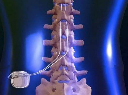 下肢截瘫康复成功案例,全国治疗截瘫最新突破