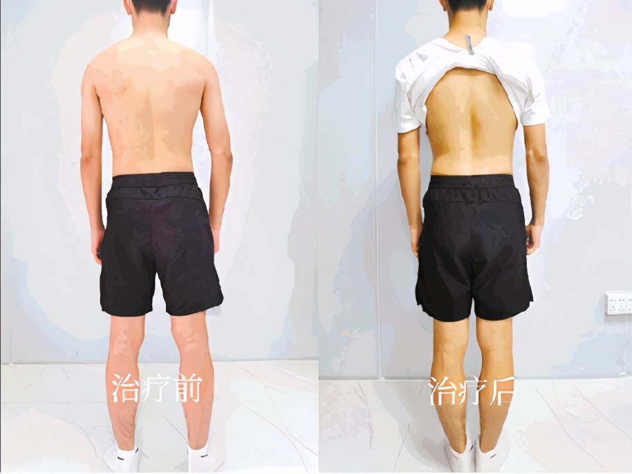 男孩纠正脊柱侧弯最好的锻炼方法,14岁学生脊柱侧弯恢复训练