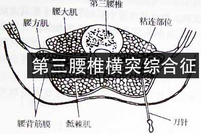 腰三横突综合征疼痛缓解方法,第三腰突综合症腰疼怎么治疗