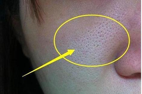 皮肤毛孔挤出黑的固体,皮肤干燥毛孔粗大该怎么解决