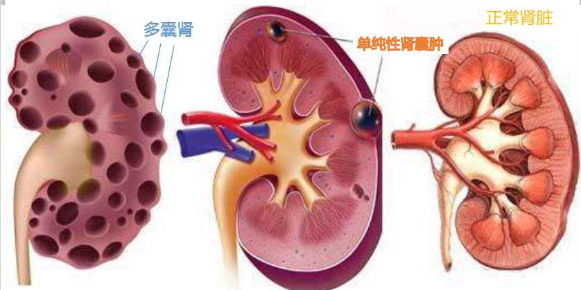 体检发现肾囊肿怎么办？医生告诉你最佳的应对方法