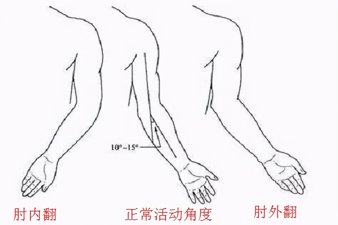 肘关节活动受限建议手术吗,肘关节钙化屈肘受限完全康复