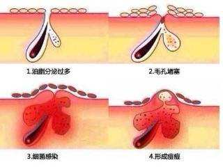 “毛孔”大作战!抓紧时间行动起来~
