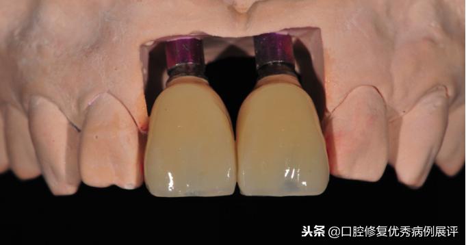 展评优秀病例赏析|Asc全瓷角度基台一体冠进行种植前牙美学修复