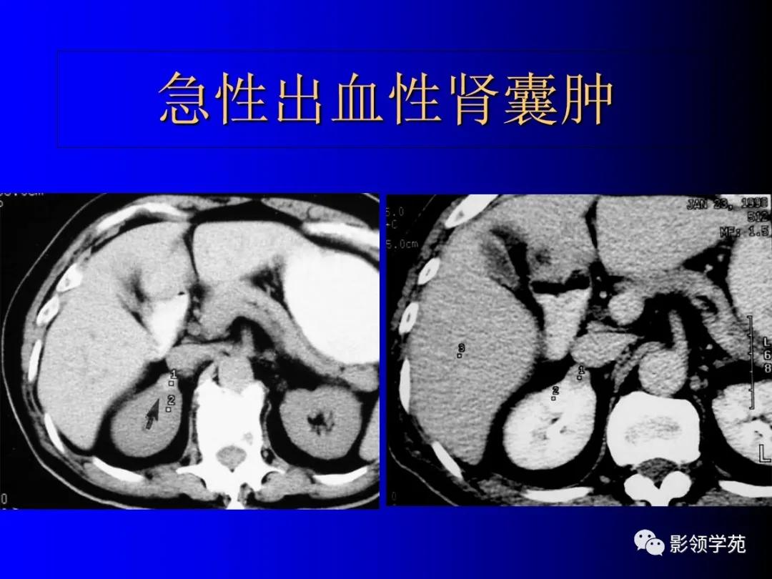 肾脏囊性肿块的影像学特点,肾脏典型病理图片及解析