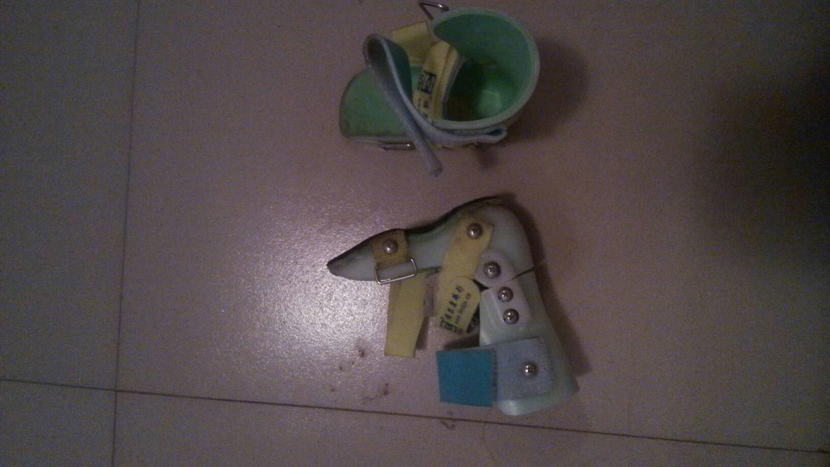 足外翻最佳治疗时间几岁,足外翻最佳治疗时间