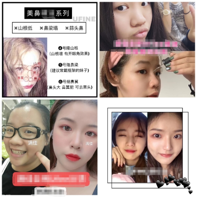 塌鼻子毁了多少人！你的塌鼻子有救了！！！