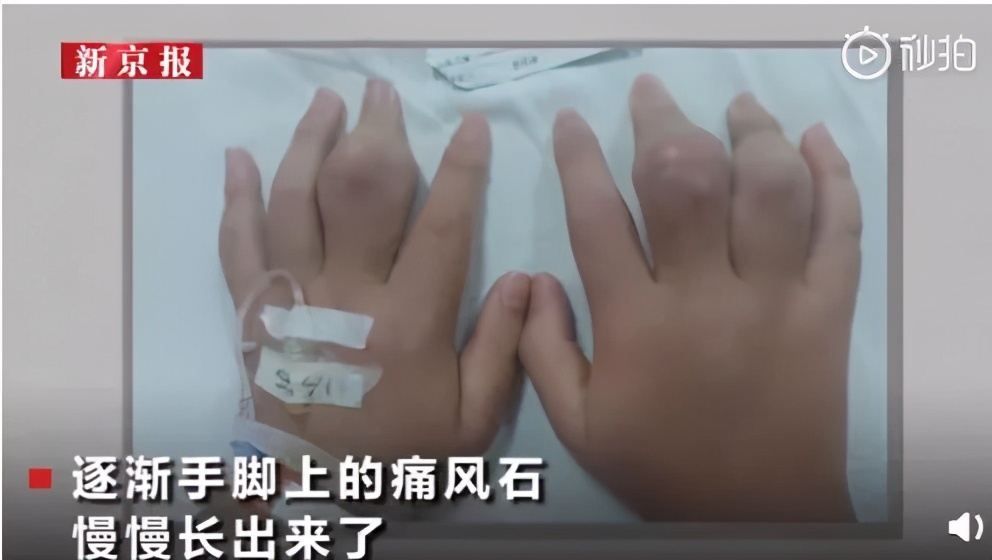 12岁男孩喝饮料导致痛风视频,14岁男孩喝奶茶痛风辟谣