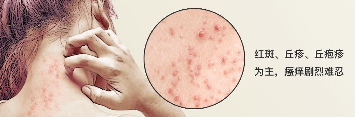 婴儿耳后的湿疹需要涂抹什么药物,湿疹急性期可选用最适合的药物