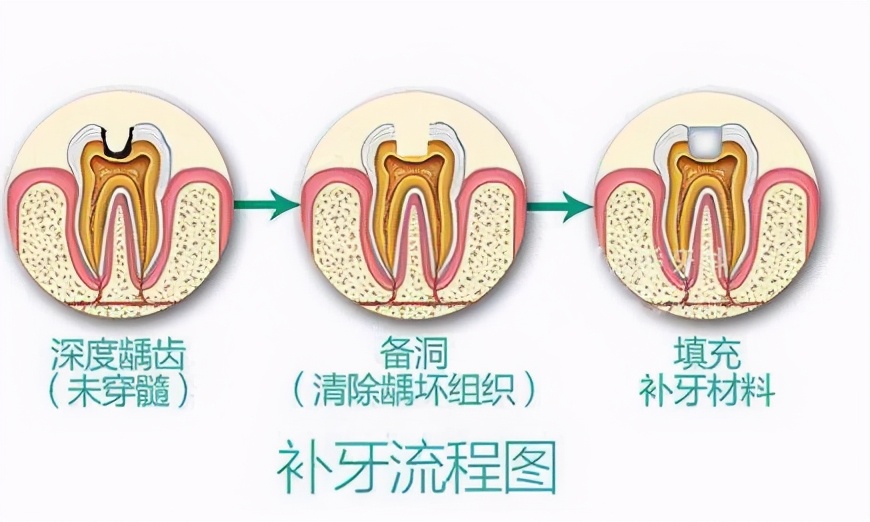 牙齿深龋建议补牙怎么补,牙齿龋坏是拔掉好还是补
