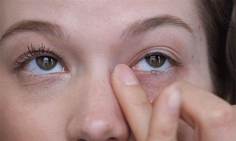 皮肤松弛引起的眼袋怎么祛除,祛除眼袋的小妙招红霉素软膏