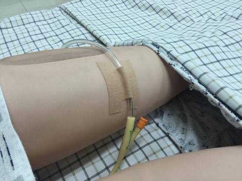 肝癌手术都需要插什么管子,肝癌术后为什么还有结节