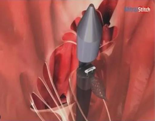 心脏“小门”关不严,经导管二尖瓣介入治疗,不开胸就换瓣