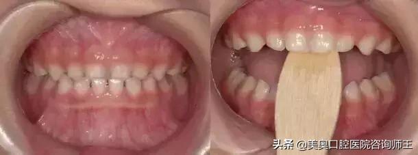 牙齿矫正地包天多久能看到效果,地包天越早矫正越好吗