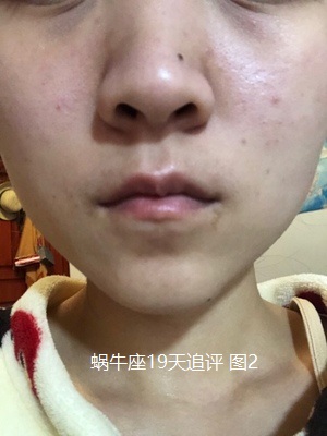 痘痘没了留下红色印记咋办,痘痘没了留下痘印怎么解决