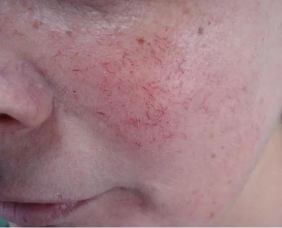 AD可能影响孩子的睡眠、教育、发展和自尊心,但激素药膏要慎用