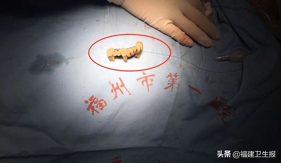 大爷误吞假牙8天后就医,大爷误吞假牙视频