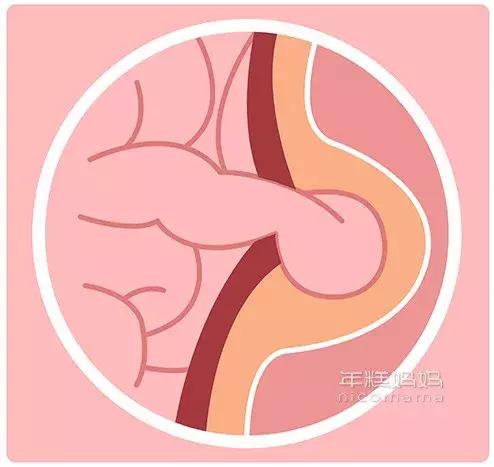 小儿疝气术后护理,小儿疝气是什么原因怎么治疗