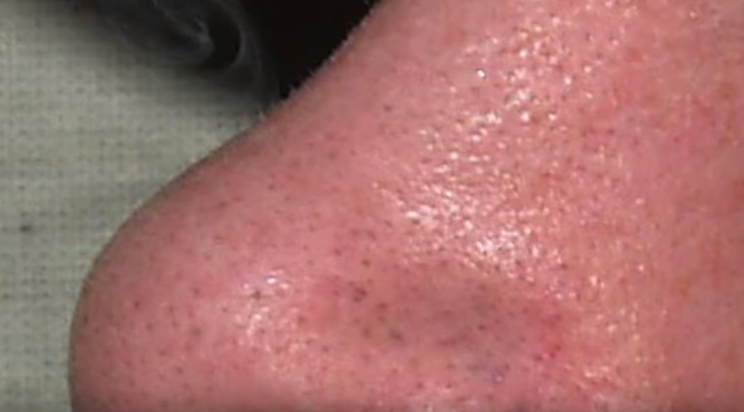 粉刺黑头真的没办法治疗吗,黑头粉刺不要清理会怎样