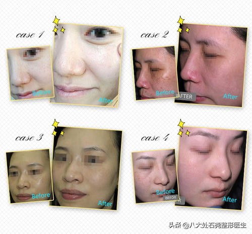 光子嫩肤会让皮肤变薄吗,长期光子嫩肤皮肤会变薄吗