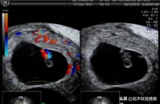 3毫米卵黄囊未见胎芽正常么,40多天的卵黄囊
