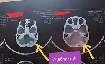 硬膜外血肿意识清醒需要手术吗,急性硬膜外血肿可做什么检查