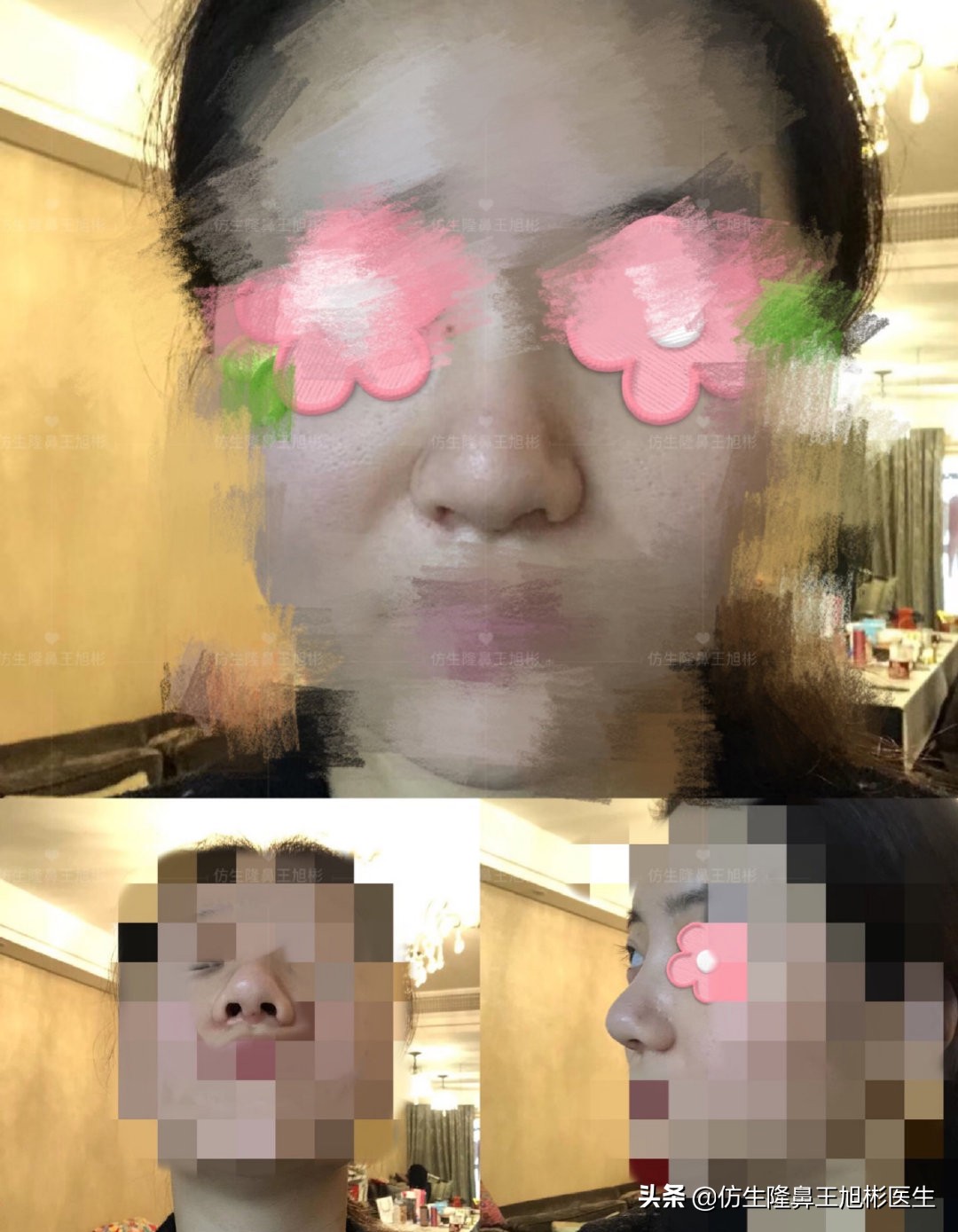 隆鼻鼻头大是失败了吗,大鼻头隆鼻手术案例