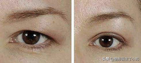 切眉提眉术后需要注意哪些事项呢,提眉术后拆线后有哪些注意事项