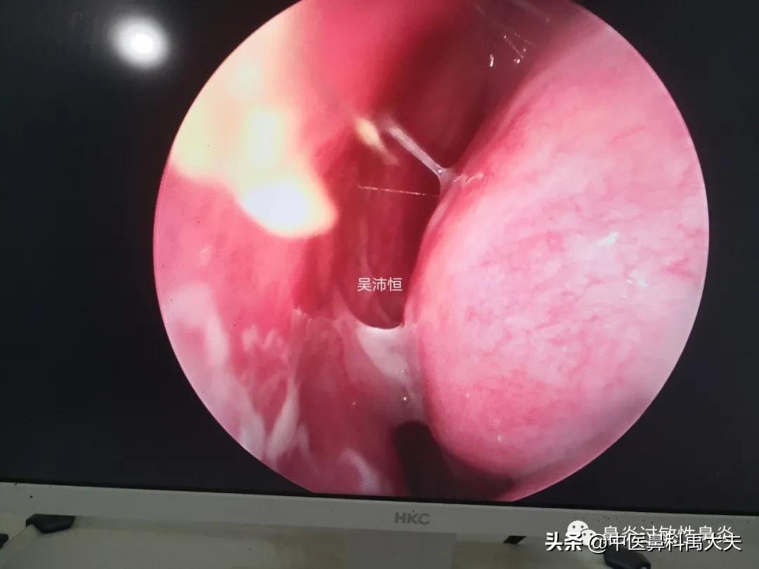 慢性鼻窦炎持续鼻塞头痛怎么治,小孩鼻窦炎长期黄脓鼻涕吃什么药