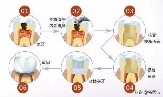 根管治疗戴冠后里面的牙还会烂吗,根管治疗戴冠后一周出现疼痛