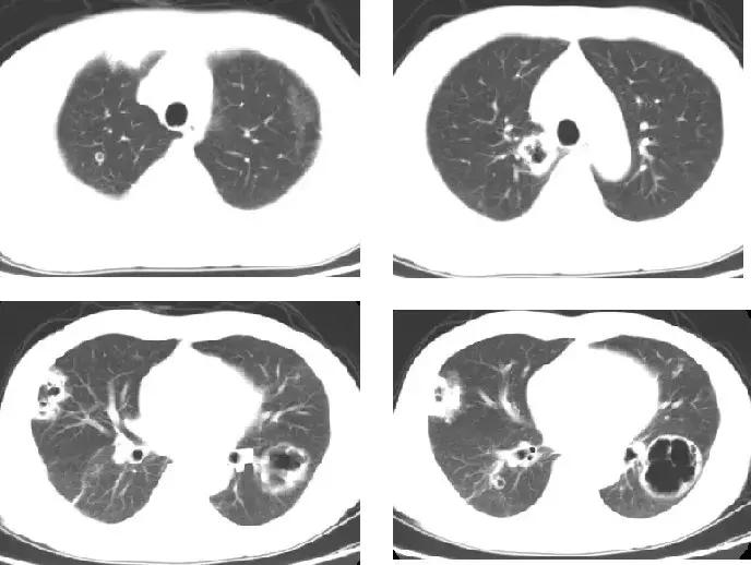 PCCM直播丨中年装修工人双肺多发空洞，奴卡菌＋曲霉菌如何治疗？