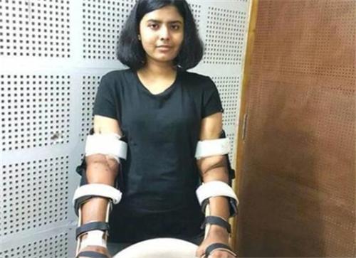 印度女孩因车祸失去双臂，谁知移植黑人手臂后，皮肤竟开始变黑