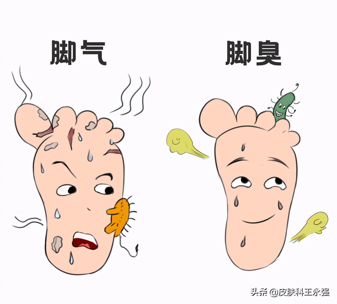 脚气如何根除教你四个方法,夏天脚气怎么根除小妙招