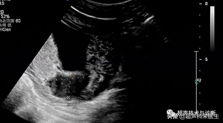 绒毛膜下血肿的超声图像,绒毛膜下血肿一般有啥症状