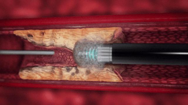 我院成功为复杂冠心病患者行准分子激光冠状动脉内斑块消蚀术