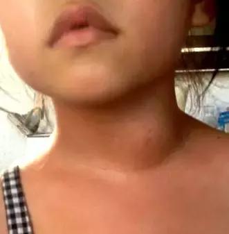 脖子上长痣小肉粒,脖子上长小肉粒要注意啦