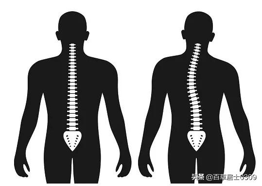 长期驼背导致脊椎凸起怎么办,年纪轻轻就驼背怎么矫正