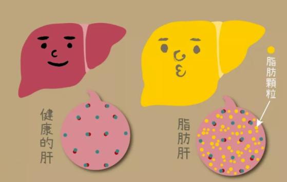 乙肝加重度脂肪肝严重吗,乙肝脂肪肝肝郁气滞