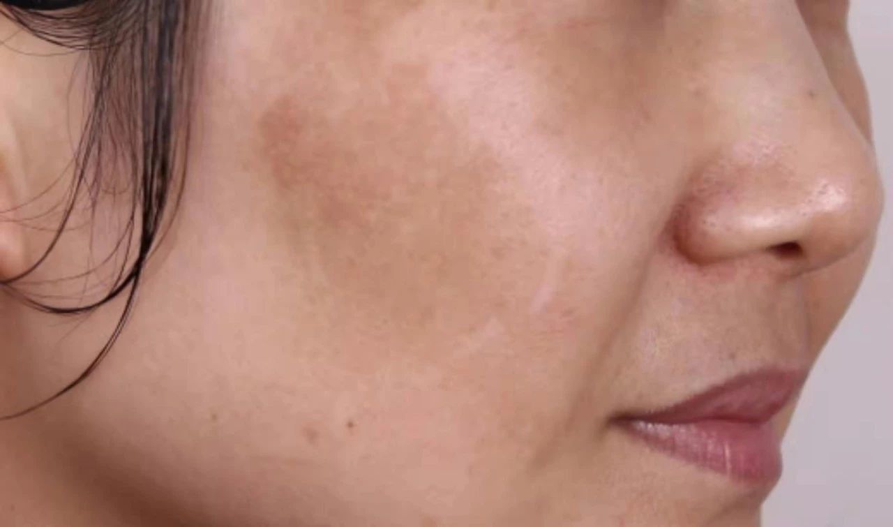 祛除褐青斑的最好方法,褐青色斑选择什么方法祛好点