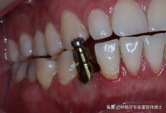 全冠修复与种植区别,全口即刻种植修复详细流程介绍