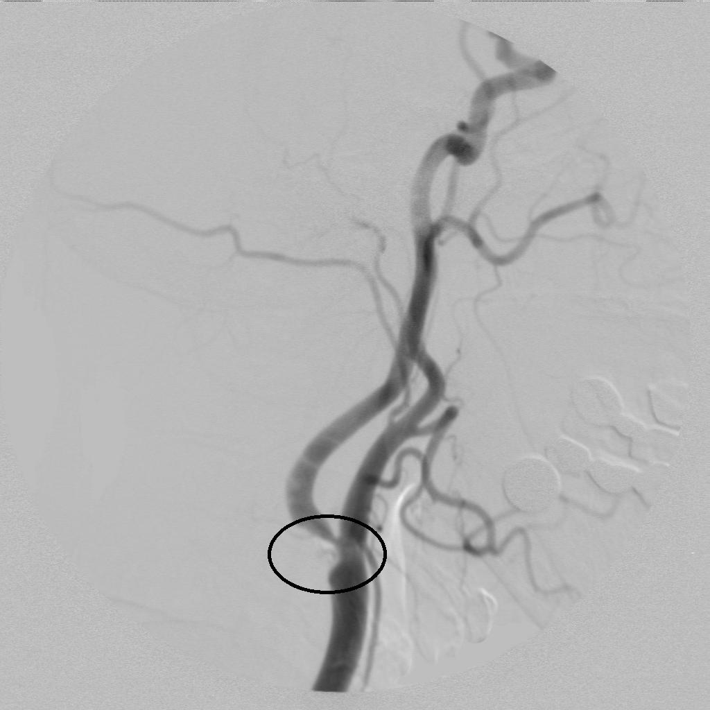 脑卒中超早期康复科普,1分钟了解脑梗