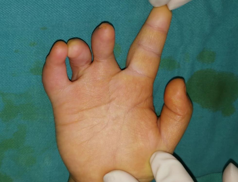 并指畸形免植皮案例,并指畸形