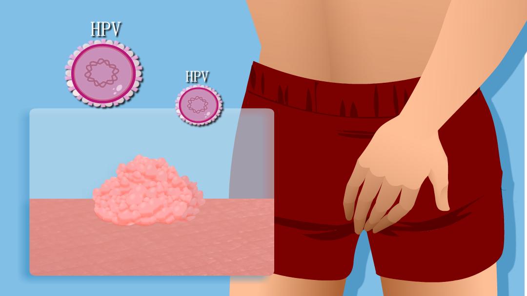 小伙子长了湿疣,一男性查出hpv长疣体