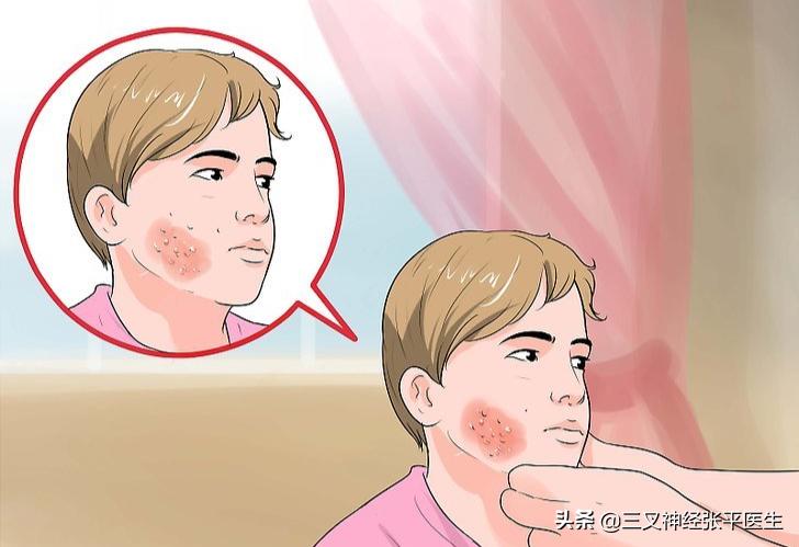 三叉神经带状疱疹后遗症案例,带状疱疹后的三叉神经痛怎么办