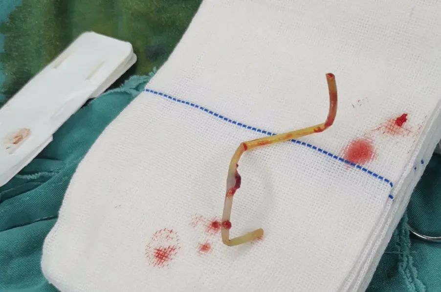 【惨痛】泸州小伙尿道里取出4个异物