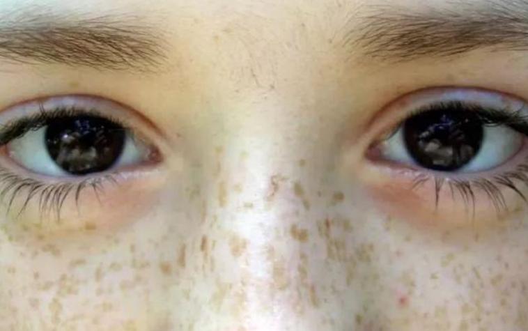 脸上雀斑多？3个方法，将“它”连根拔起，心情瞬间美丽了