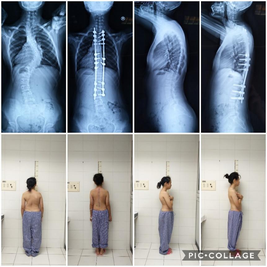 北京青少年脊柱侧弯矫正最佳方法,北京脊柱侧弯校正