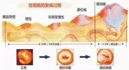 cin癌前病变什么意思,辟谣得了癌不治能活得更久