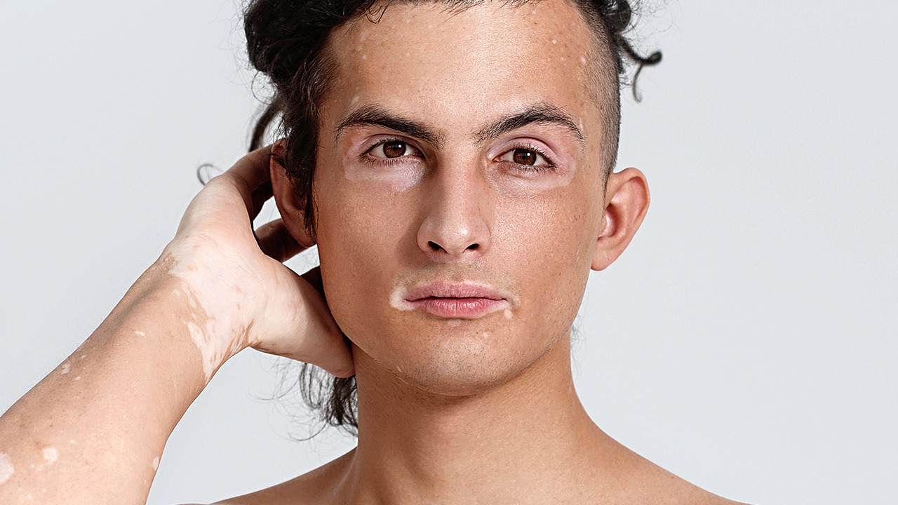 伍德灯检查白癜风准确率,医院里的臀部白癜风检查