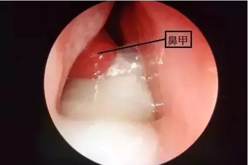 宝宝流鼻涕有什么好的解决方法吗,宝宝流鼻涕有什么好的解决办法